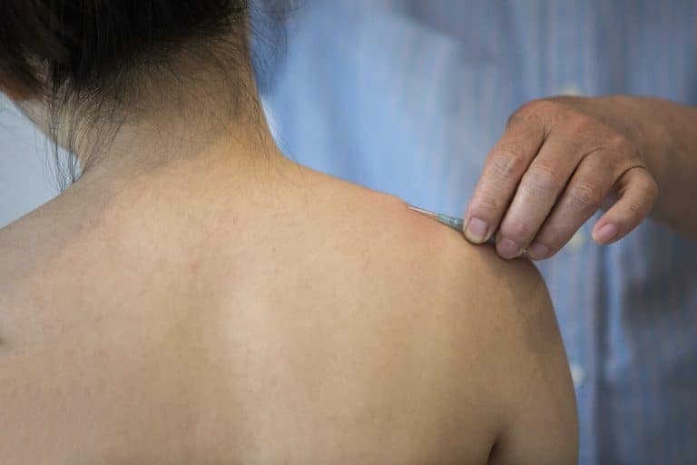 Acupuncture Needle treatment in shoulder of woman.